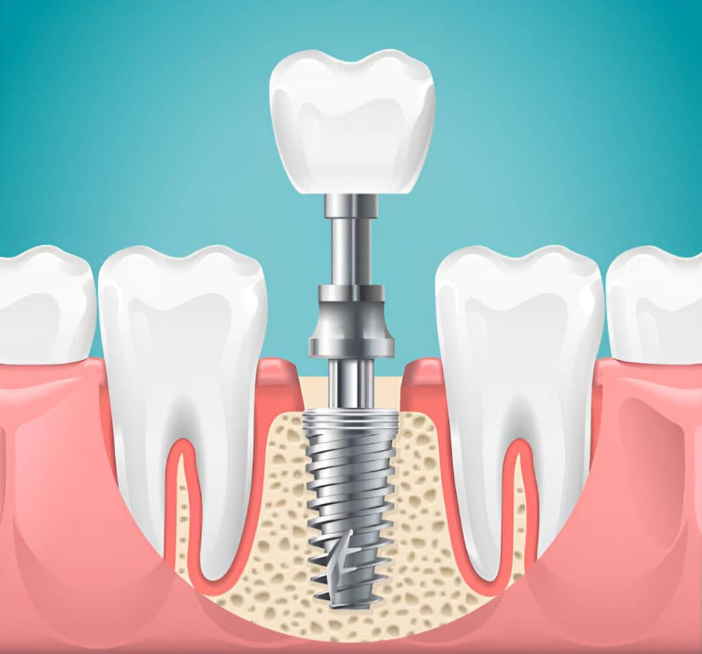 Dental implants in Burlington