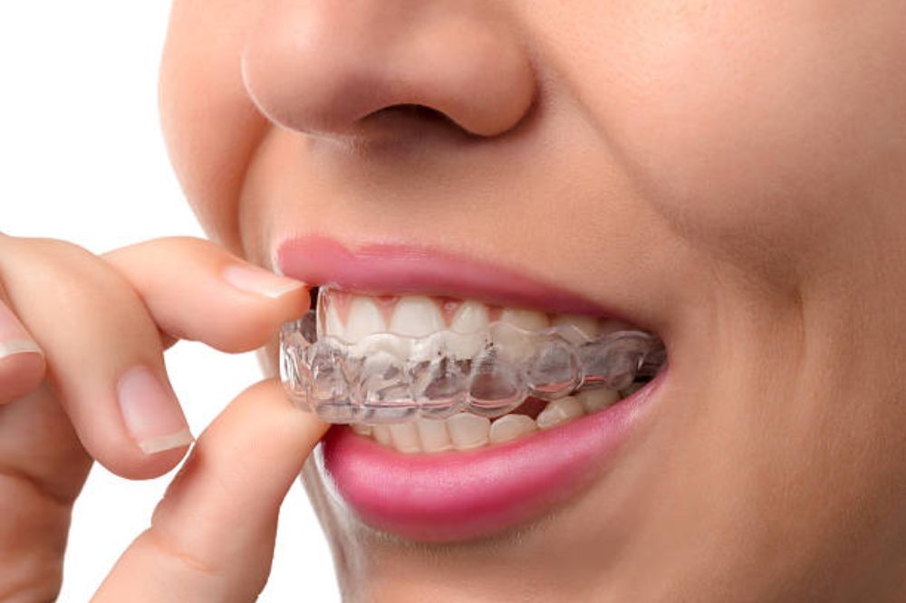 invisalign in Burlington