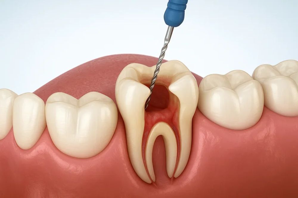 Root Canal Therapy