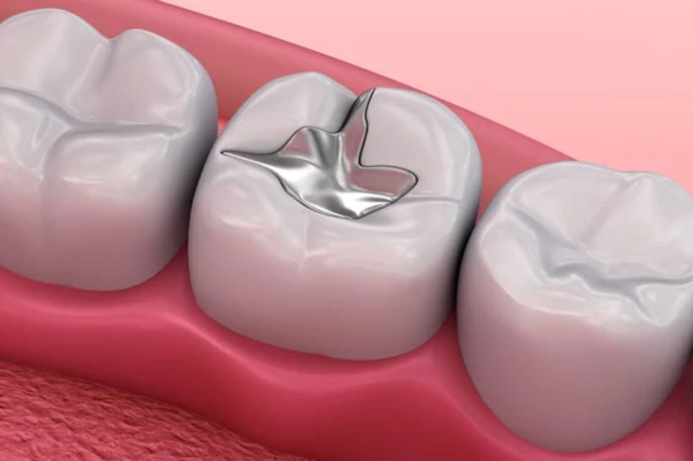 Dental Fillings in Burlington