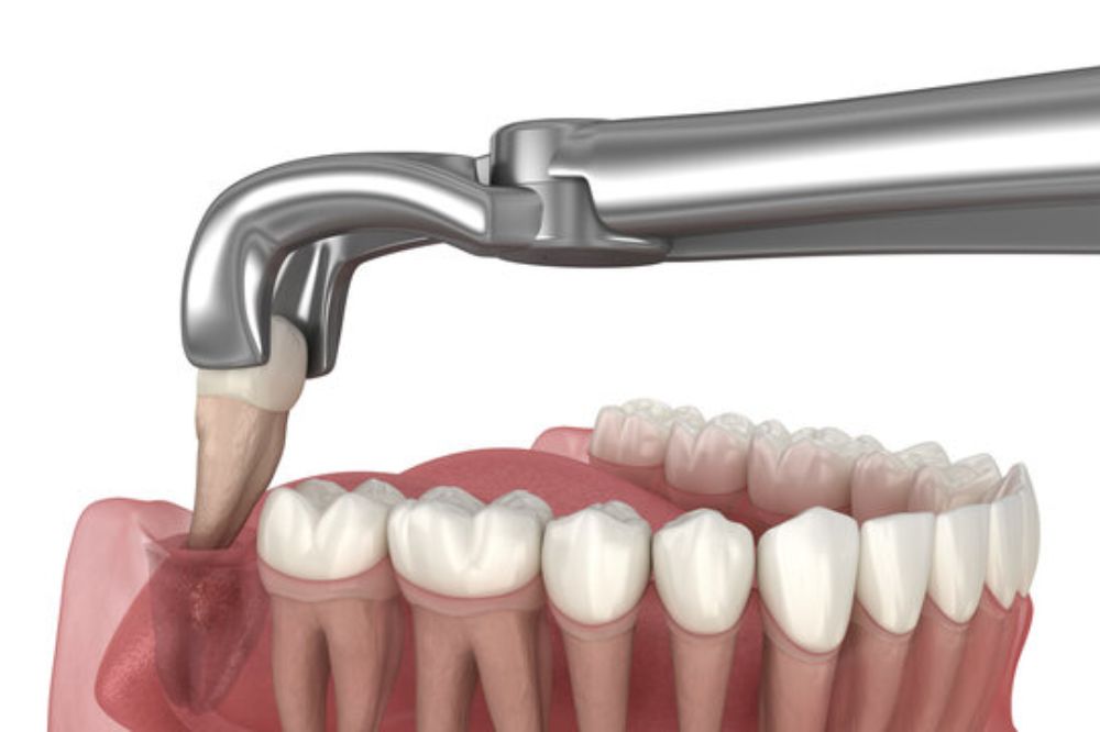 wisdom teeth removal in Burlington