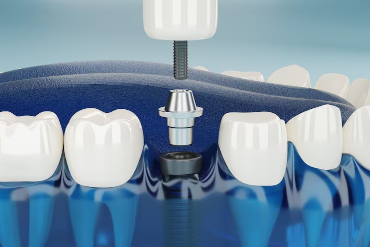 dental implant crown placement process for restoring a missing tooth