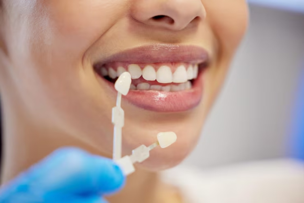 dentist matching porcelain veneer shade on a patient's front teeth